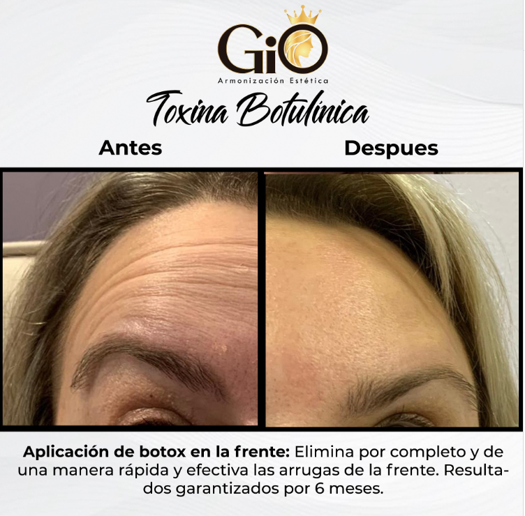 gio centro estético botox